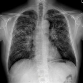 Frontal and lateral chest radiograph