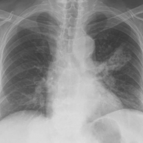 Frontal chest radiograph