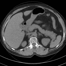 Non-contrast-enhanced CT of abdomen