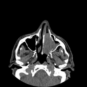 Axial non-contrast CT - soft tissue window