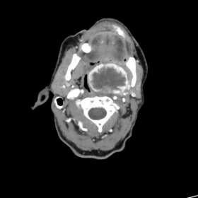 Axial CT scan with intravenous contrast