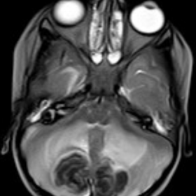 MRI brain T2-weighted image