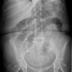 Abdominal X-ray
