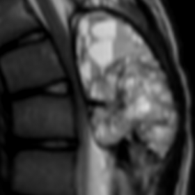 MRI T2 FAT SAT-weighted Sagittal