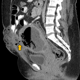Contrast-enhanced CT in portal phase, sagittal projection