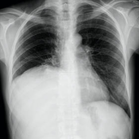 Chest radiograph (CR)