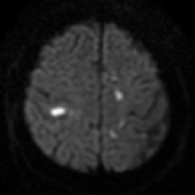 Axial diffusion weighted image