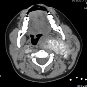 Axial CT scan of the neck with IV contrast