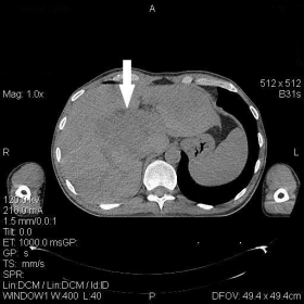 Native pre-biopsy abdominal CT scan