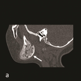 Maxillofacial bones Computed Tomography (CT)