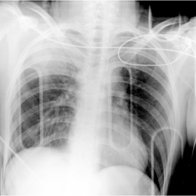 AP chest x-ray
