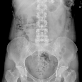Plain abdominal radiograph