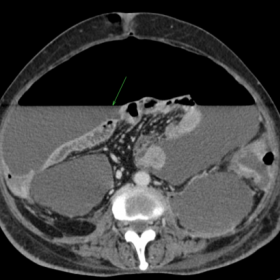 Axial contrast-enhanced CT abdomen
