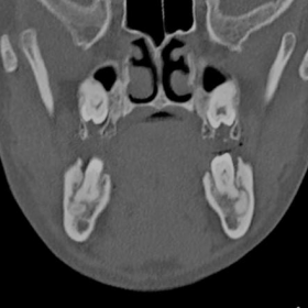 Coronal CT, bone window
