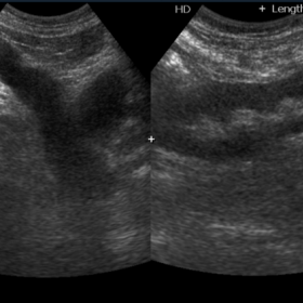 Renal graft B mode Doppler evaluation demonstrating normal corticomedullary differentiation