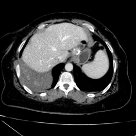 Diaphragmatic angioma. CT images.