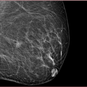 Breast fibromatosis