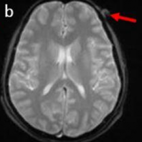 Axial MRI brain