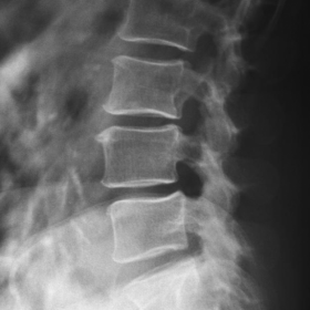 Lombar X ray