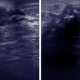 Ultrasound: calcifcation and soft tissue mass