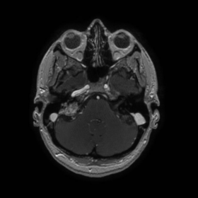 Axial contrast enhanced T1 weighted MRI