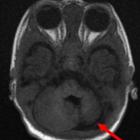 Axial MRI BRAIN T1W image