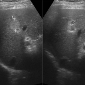 First abdominal ultrasound