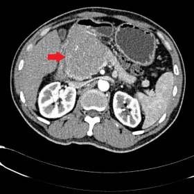 Axial CT pancreas
