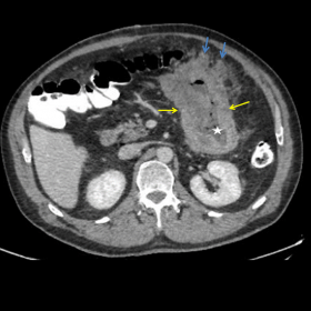 Abdominal contrast-enhanced CT (axial and sagittal plane)