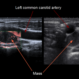 Doppler colour and B-mode ultrasound scan