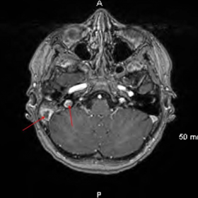 Post-contrast axial T1 MRI