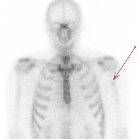 Technetium-99m bone scan