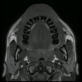 Axial T1W images of lips