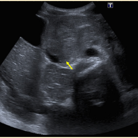 Axial images of the superior retroperitoneum of abdominal US