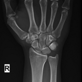 X-Ray of right wrist AP and lateral view