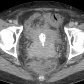 Axial CT: Intra-uterine device (IUD)