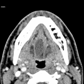 Axial contrast-enhanced CT of the neck