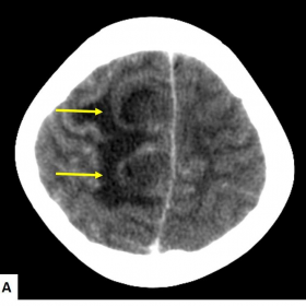 CECT Brain - Axial images