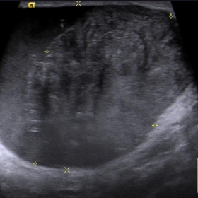 Sonography- Left breast
