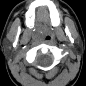 MDCT axial images at the maxillary alveolar ridge level
