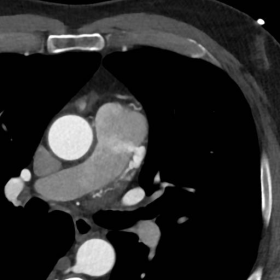 Contrast-enhanced, ECG-triggered coronary CT examination axial images