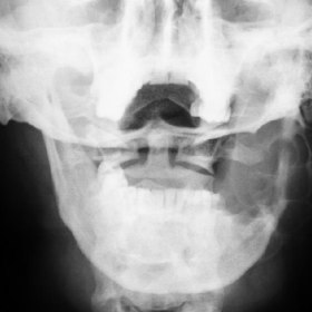 Radiography of the mandible.