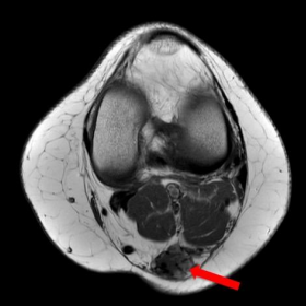 Axial T1-weighted image after contrast administration