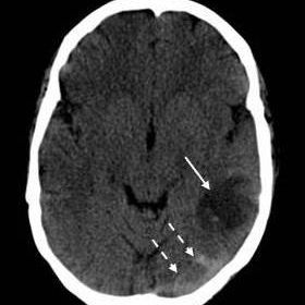 Non-enhanced CT of the brain after a first seizure episode