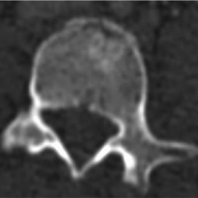 Coned Axial CT - Bone windows
