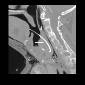 Cervicothoracic computed tomography (CT) with intravenous contrast