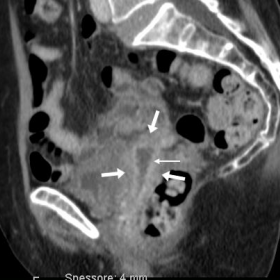 Contrast-enhanced multidetector CT (4 days after vaginal hysterectomy)