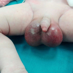 Swollen infant testicles