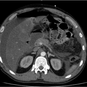 CT abdomen axial portal venous phase