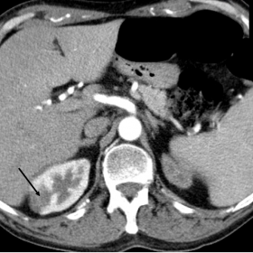 Small right renal infarct